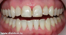 долеченные каналы зуба