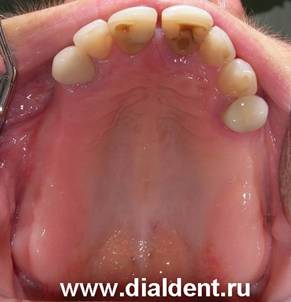 вид верхних зубов до лечения