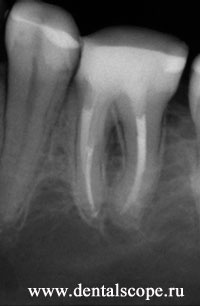 восстановление зуба композитным материалом