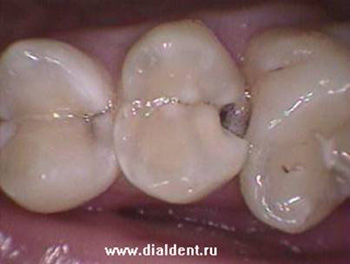 кариес жевательного зуба