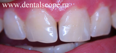 лечение потемневших зубов - результат