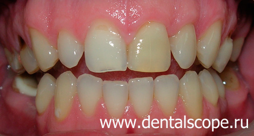 перелечивание каналов зуба и внутреннее отбеливание зуба
