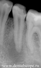 на рентгене зуба видно затемнение