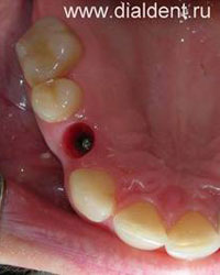 замещение разрушенного зуба имплантом