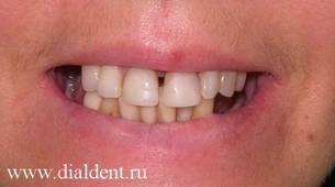 вид улыбки до лечения
